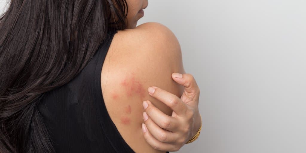 uczulenie na kwas hialuronowy